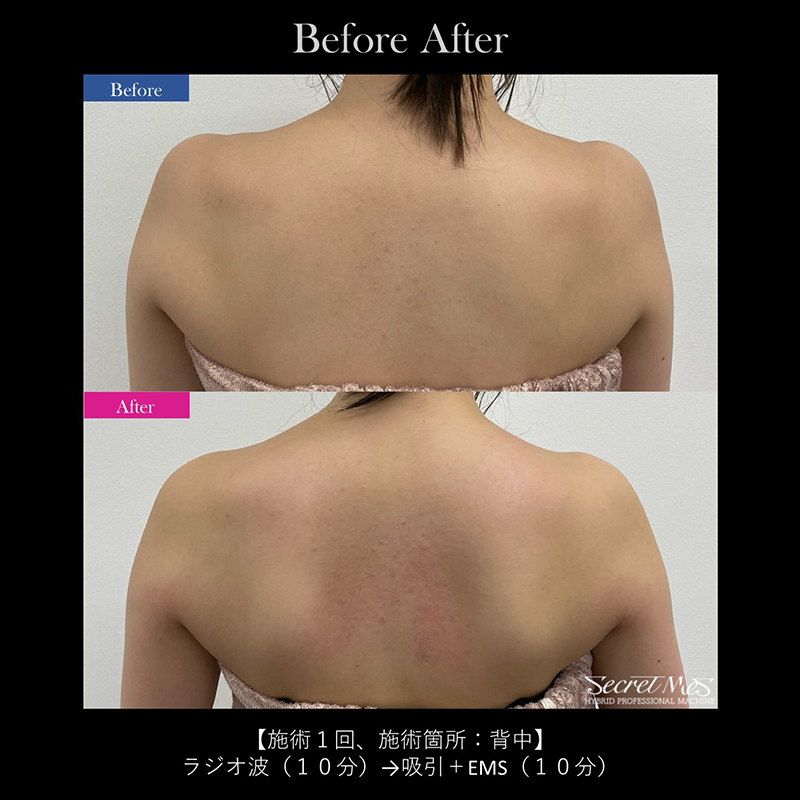 ☆キャビテーション × ラジオ波