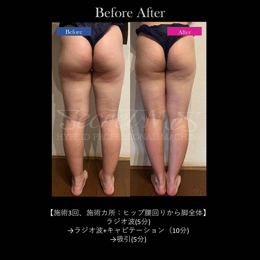cavitation_img012.jpg